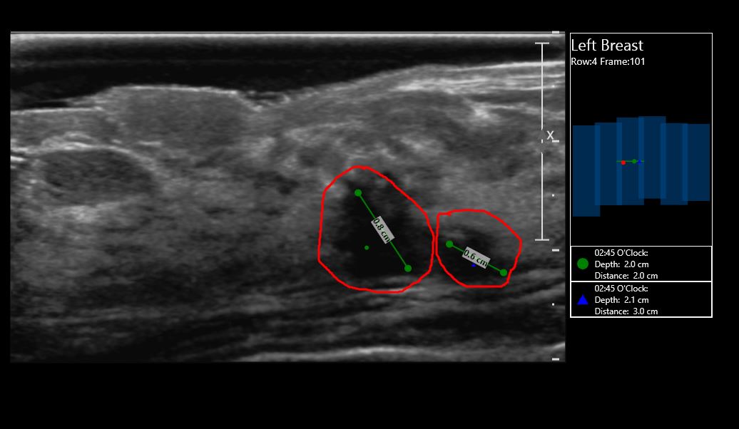 SonoCine Case 2 Cancer