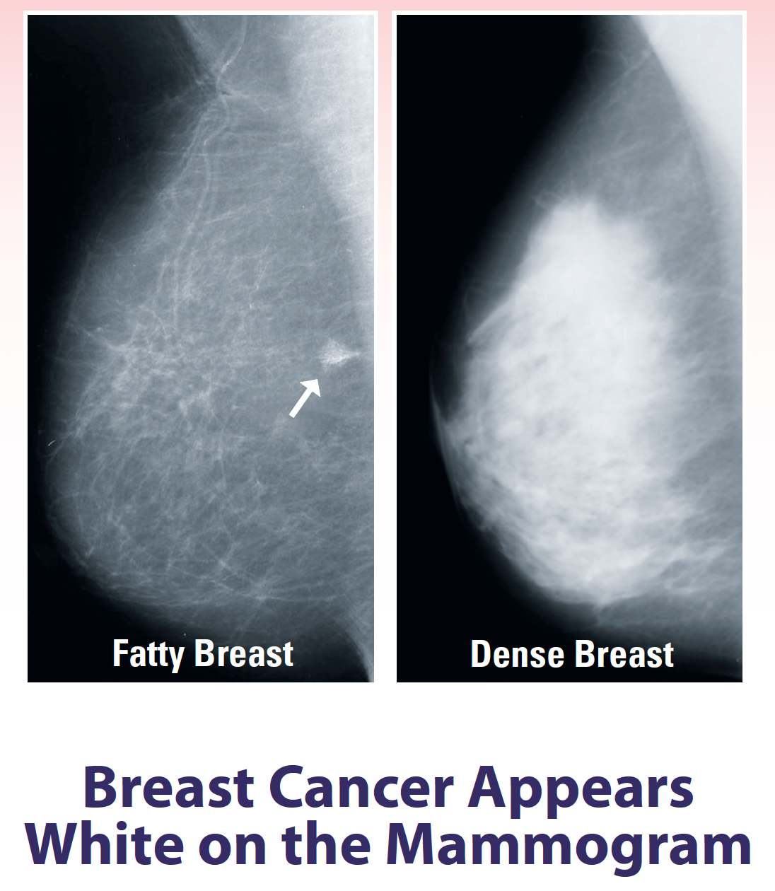 Dense Breast